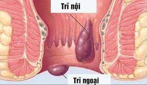 Bệnh trĩ là gì?