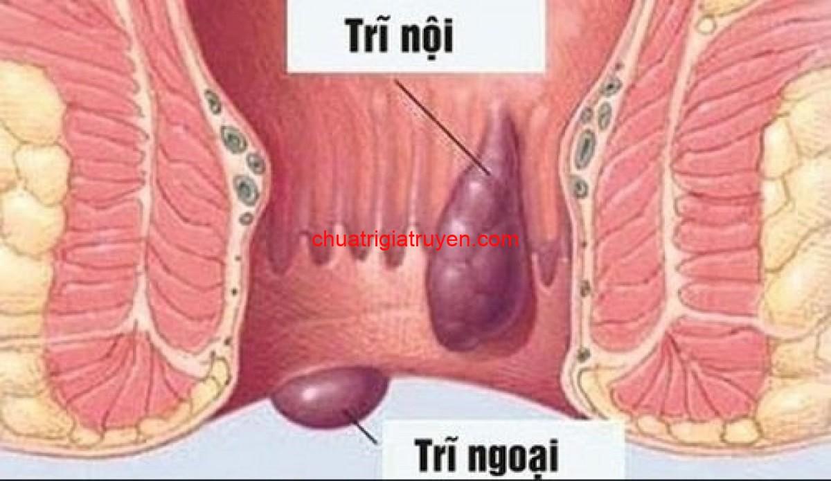 Tắc mạch trĩ ngoại có triệu chứng gì?