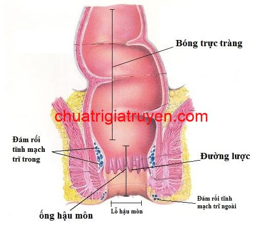 Bệnh trĩ