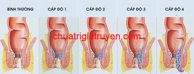 các cấp độ bệnh trĩ