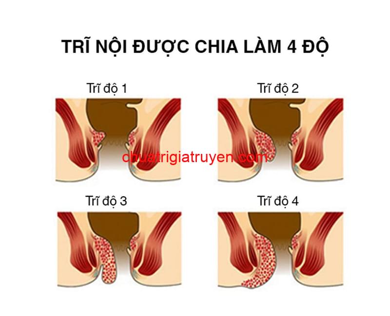 Các cấp độ trĩ nội