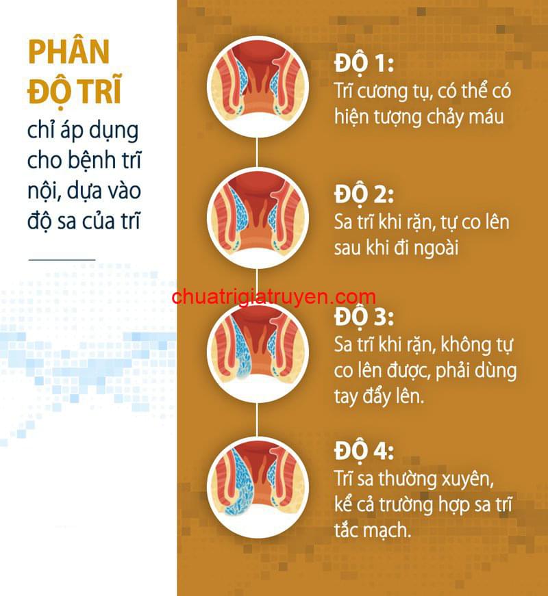 Các độ của bệnh trĩ