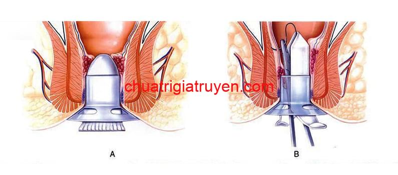 Các phương pháp chữa bệnh trĩ bằng tây y