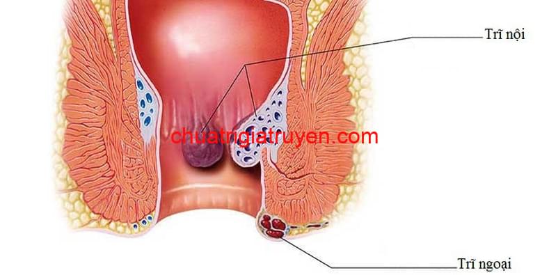 Dấu hiệu và triệu chưng của bệnh trĩ ngoại