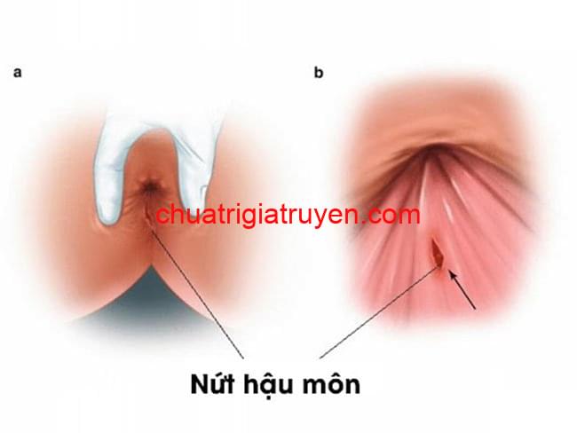 Nứt hậu môn