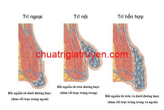 Phân loại các loại bệnh trĩ