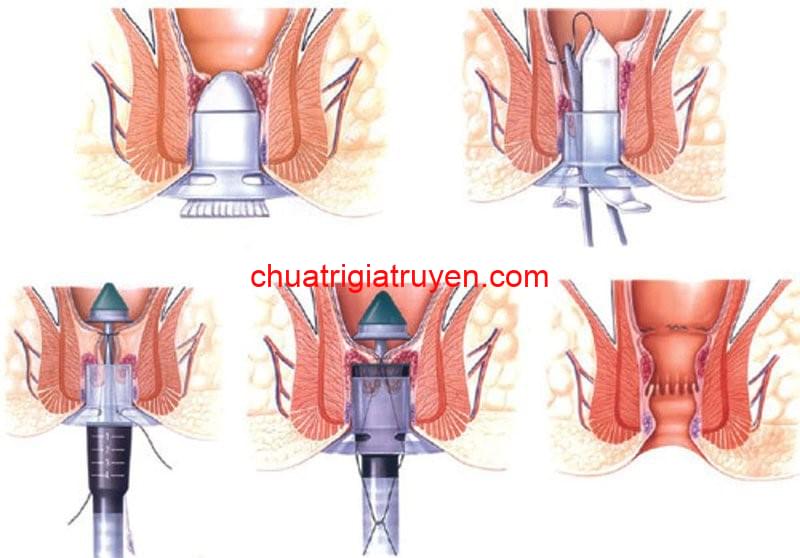 Phương pháp cắt trĩ