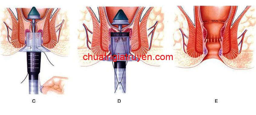 Các phương pháp chữa bệnh trĩ bằng tây y