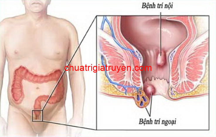 Phương pháp điều trị bệnh trĩ ngoại