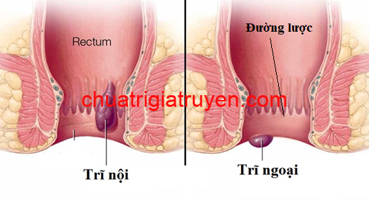 Trĩ nội trĩ ngoại